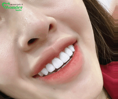 Phục hình răng sứ thẩm mỹ vệ pháp hữu hiệu giúp cảm thiện tình trạng tương phản không cần xâm lấn